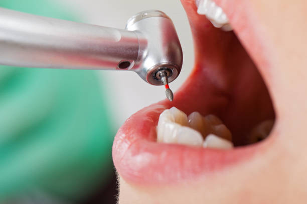 Best Emergency Wisdom Teeth Removal in Coalville, UT